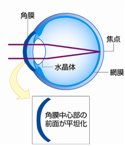 オルソケラトロジーレンズを外した後