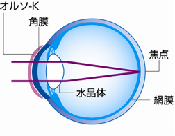 オルソケラトロジーレンズを入れているとき