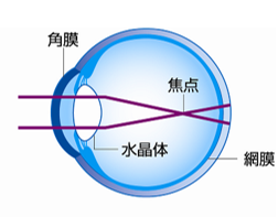 オルソケラトロジーレンズを入れる前