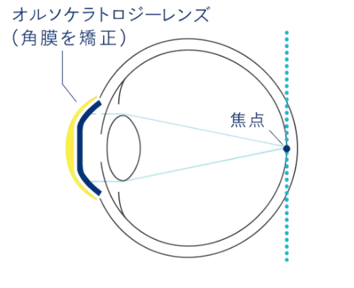 オルソケラトロジーレンズを入れているとき