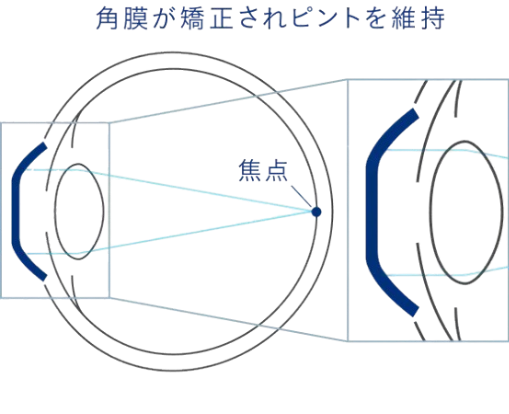 オルソケラトロジーレンズを外した後