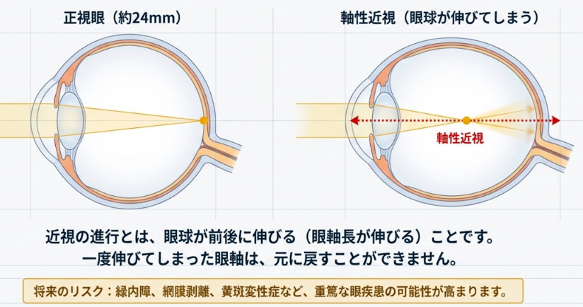 正視眼と軸性近視の違いを示す図