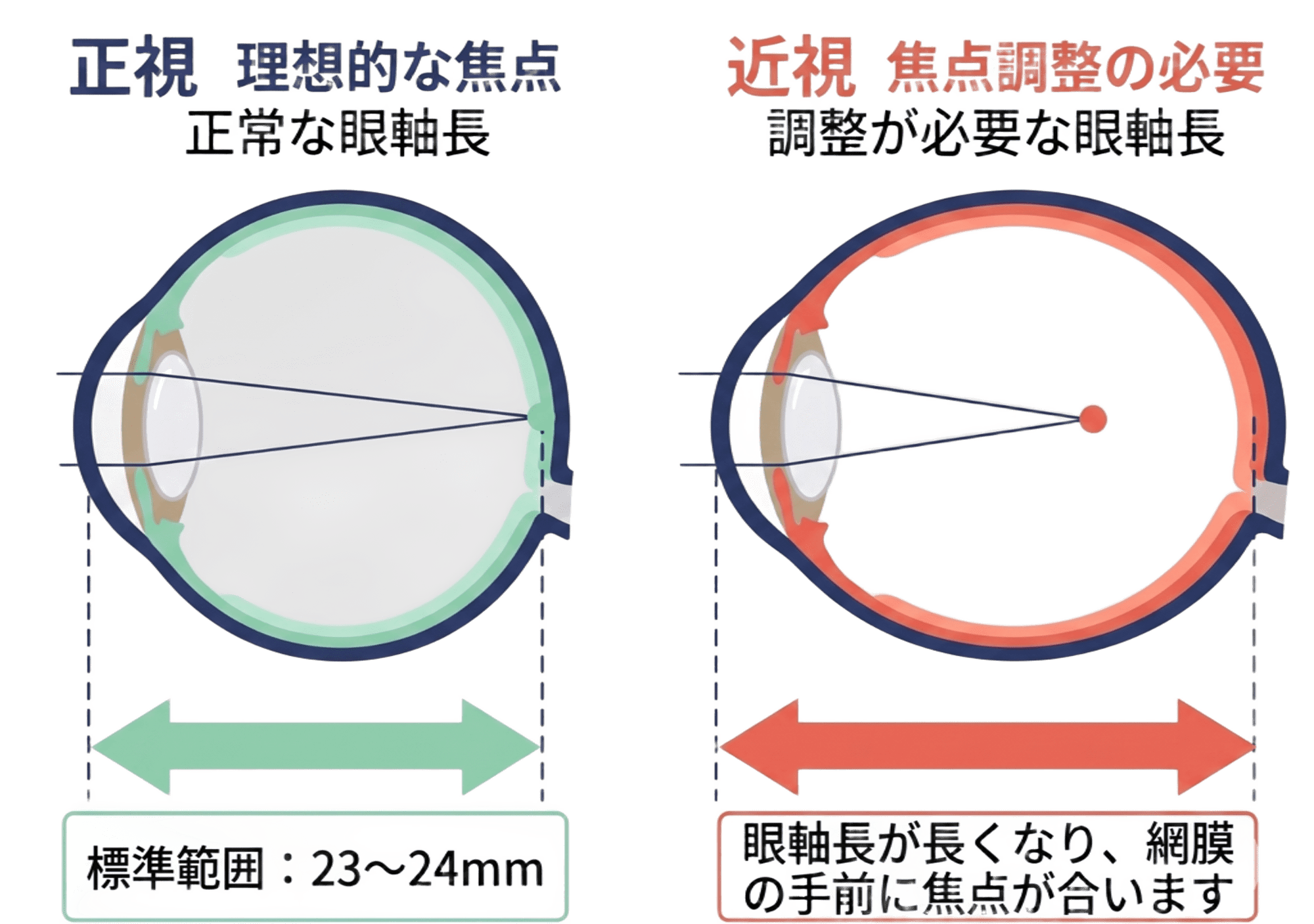 正常な眼軸と近視の眼軸の比較図