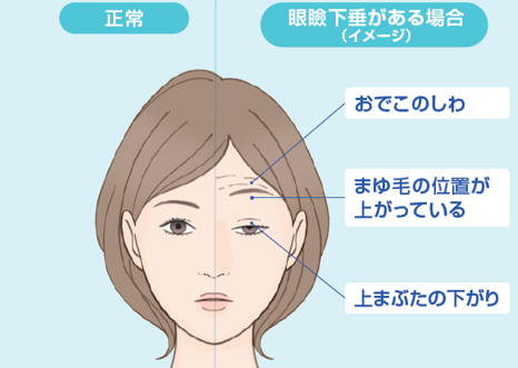 腱膜性眼瞼下垂が起こる仕組みのイメージ解説図