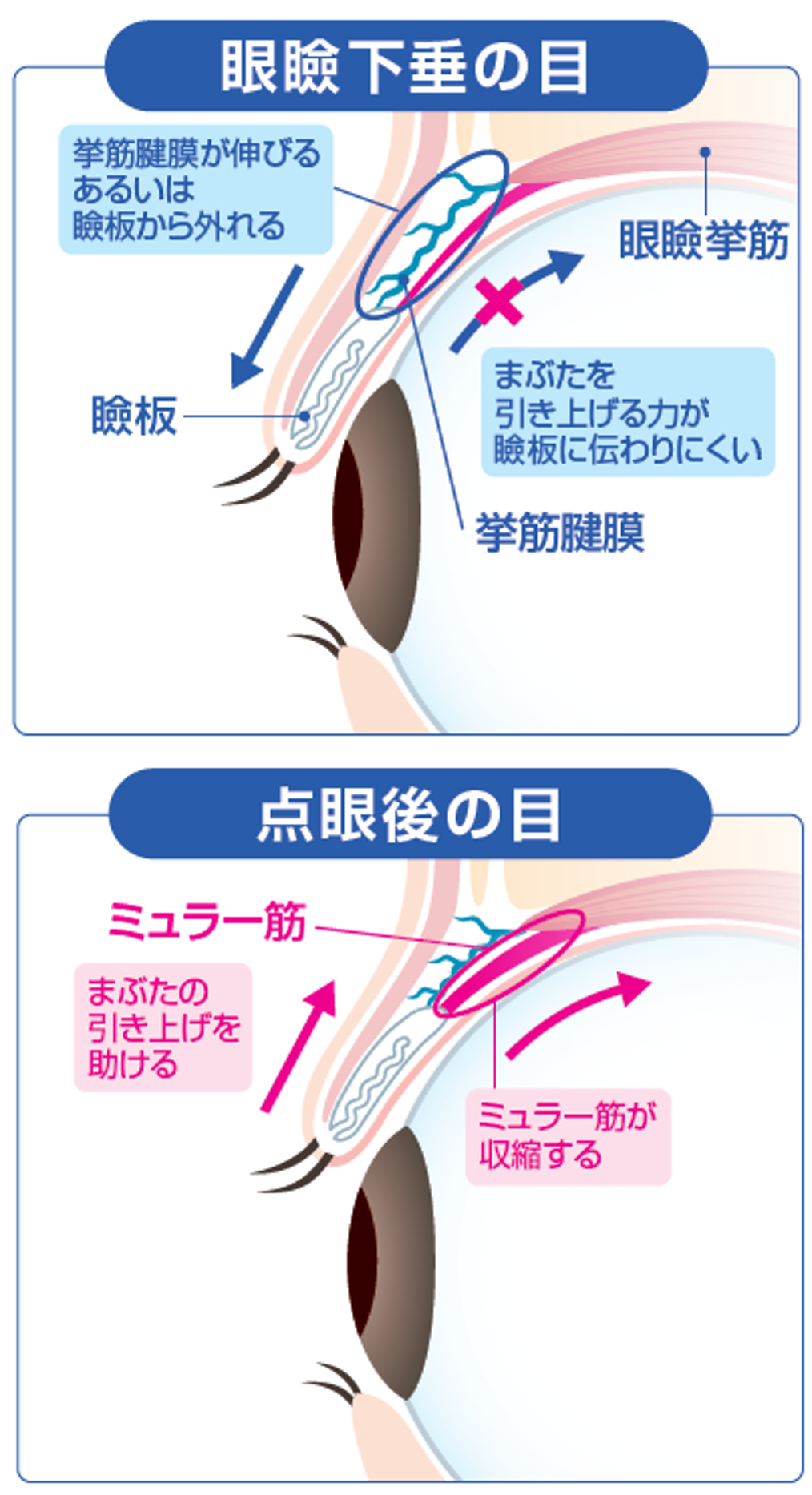 点眼後の目とミュラー筋収縮による改善イメージ