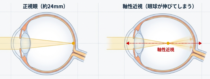 正視眼と軸性近視の違いを示す図