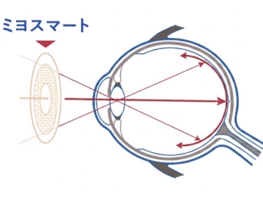 ミヨスマートによる補正